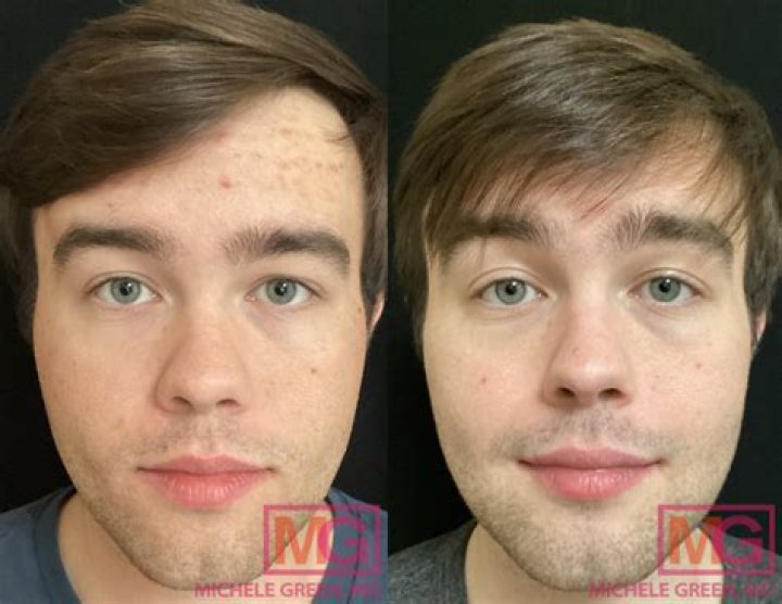 Does Accutane permanently lower testosterone?