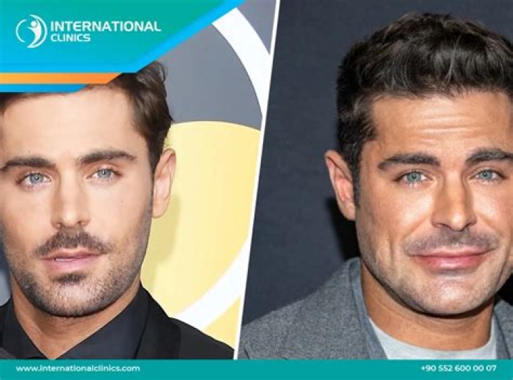 People were talking about Zac Efron’s face, but does he really look that different??