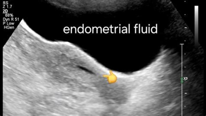 What does echogenic foci in the endometrium mean?