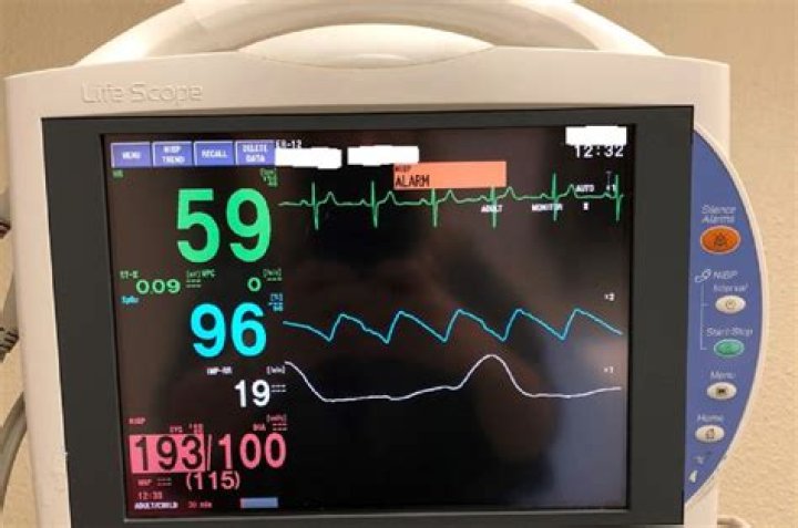 What is RR on a heart monitor?